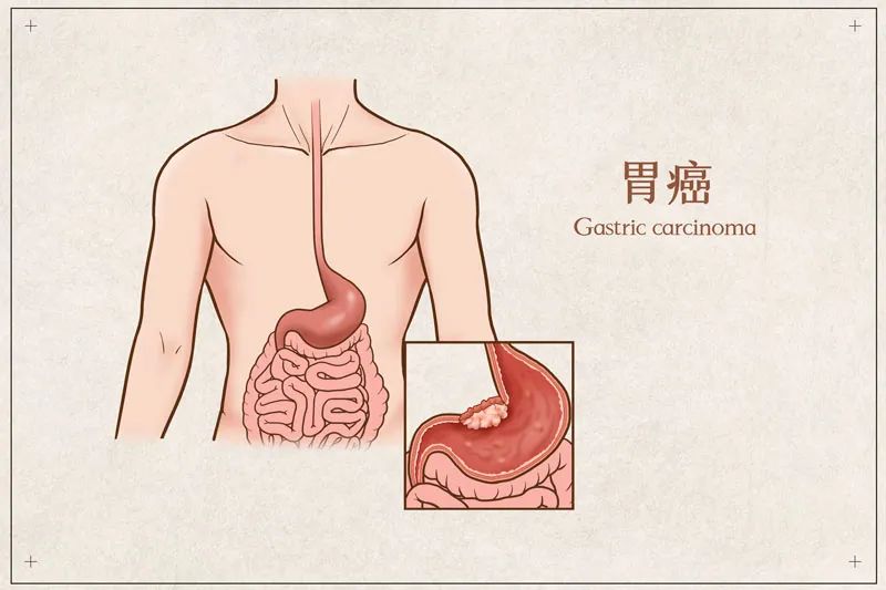 胃最怕這幾件事，多占一個(gè)離胃癌近一分！醫(yī)生：很多人一確診就是晚期