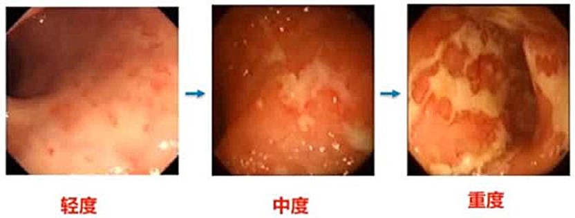 吳開春教授：潰瘍性結(jié)腸炎診治新視角 | CGC 2022
