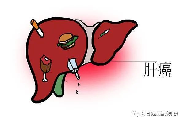 肝癌來臨，大小便先知？
