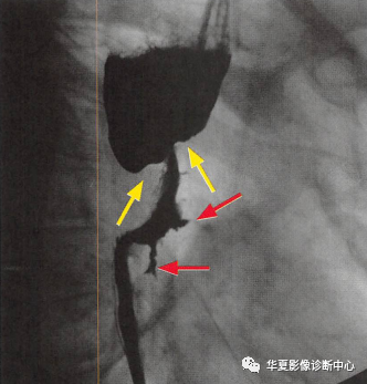 黑色玫瑰征，你知道嗎？
