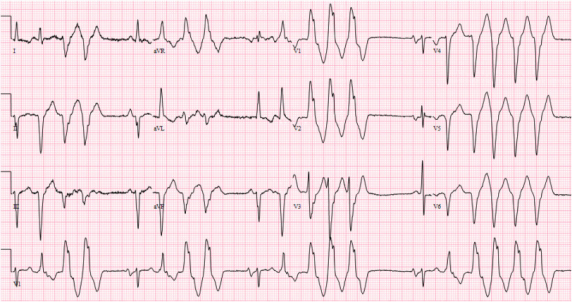 翻譯-Dysrhythmias associated with COVID18947.png