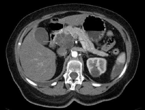 Nature Cancer：三聯(lián)免疫療法有可能治療胰腺癌