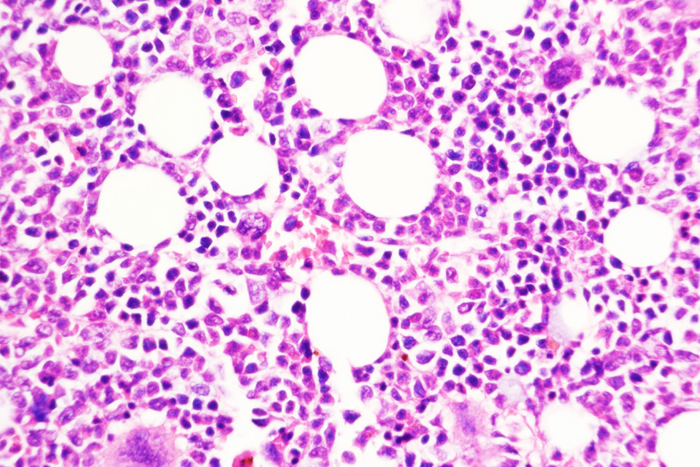 Nature Cancer揭示了慢性血癌如何轉(zhuǎn)變?yōu)榍忠u性疾病